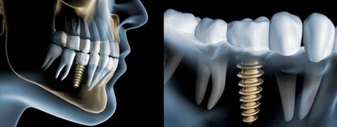 implantate-dr-rudolph-moenchengladbach